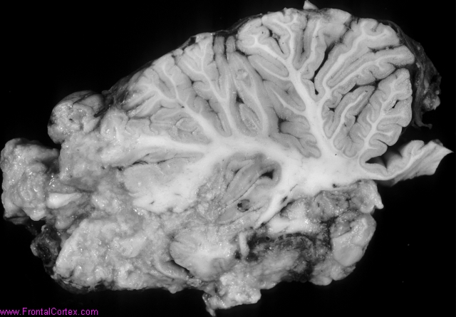 Organizing cerebellar necrosis,